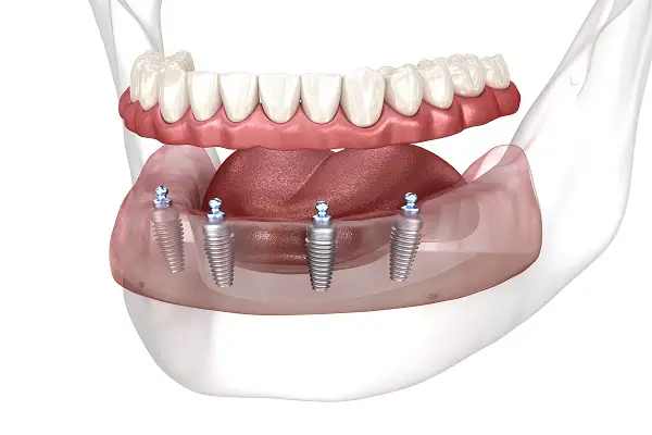 Community Oral Facial Surgery
